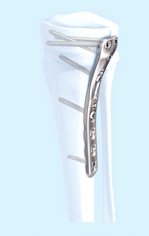 3.5 mm LCP Posteromedial Proximal Tibia Plate – Bions Medical Systems